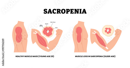 Sarcopenia or muscle wasting syndrome or muscle loss in older age or aging adult. Labeled bone marrow, flesh, muscle, fatty tissue and bone cross section. Muscle Atrophy. Healthcare illustration