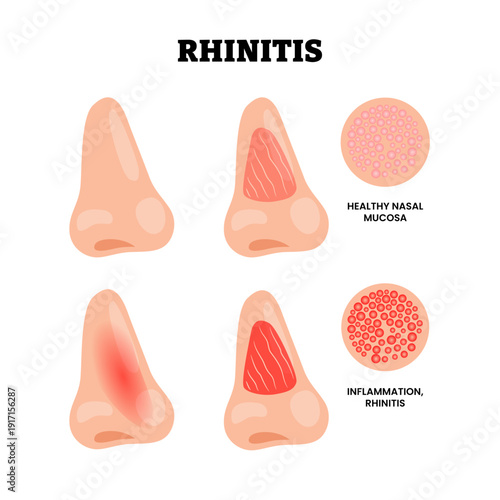 Inflammation of the nasal mucosa and Rhinitis. Nose Nasal diseases. Allergy, rhinitis, cold. Symptoms like congestion, rhinorrhea, sneezing, and itching. Sinusitis. Healthcare medical illustration.