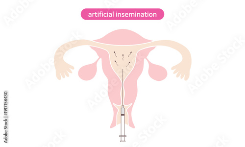 Artificial Insemination Medical Illustration