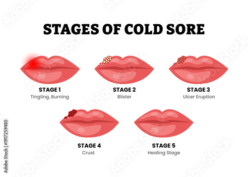 Stages of cold sore stages. Herpes labialis fluid filled blisters. Labeled burning or tingling, blister, ulcer eruption, crust, healing stage. Lips problem. Medical science educational illustration.