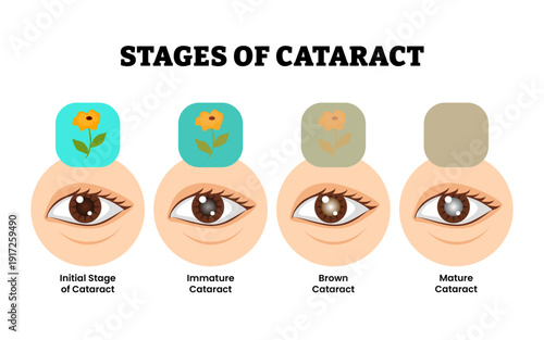 Stages of cataract stage process development. Eye disease infographic poster. Labeled initial, immature, brown and mature cataract with eye and Vision loss problem. Healthcare illustration vector.