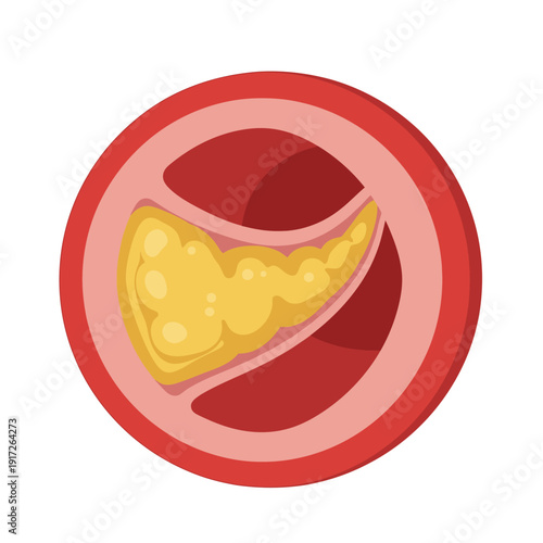 Illustration of a cross-sectioned artery with visible plaque buildup inside.