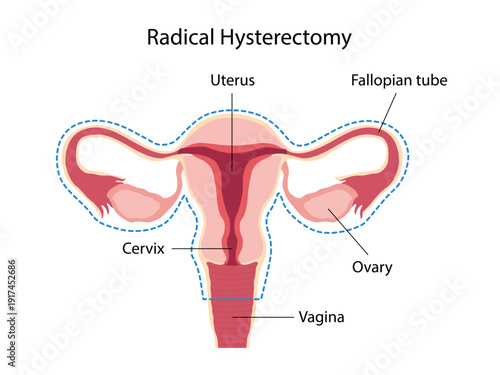 Radical Hysterectomy. Surgical removal of the uterus, cervix, ovary, fallopian tubes. Female anatomy. Vector Medical diagram for gynecology. 
