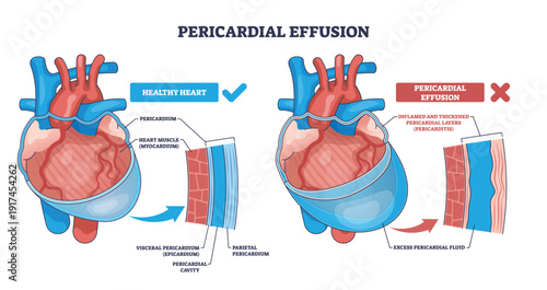 Pericardial effusion outline illustrates fluid buildup compressing the heart, contrasting normal and inflamed pericardium, key objects, heart, pericardial layers, excess fluid. Outline diagram