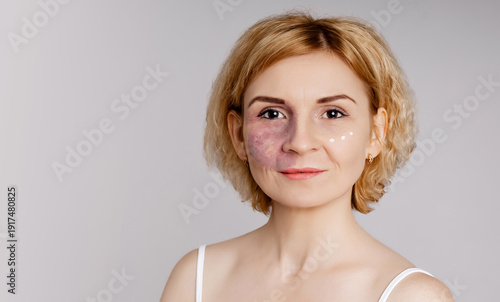Photos Woman with visible port-wine stain birthmark vascular skin condition with cream