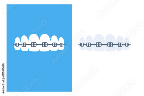 Flat design dental braces set featuring teeth with metal brackets for orthodontic treatment
