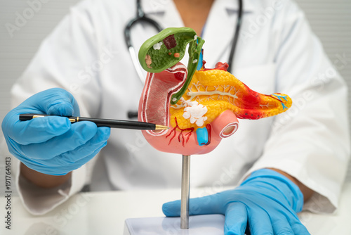 Quadro su tela Pancreatitis, pancreatic cancer, Asian doctor with pancreas, gallbladder and bile duct human anatomy model at hospital