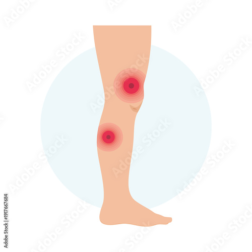 Illustration depicting human leg pain specifically localized around both knees and shin