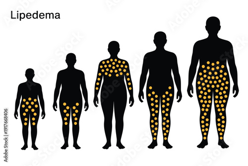 Illustrative depiction of lipedema progression through stages in human silhouettes