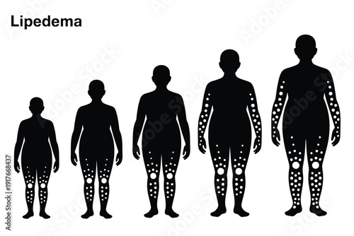 Illustrative depiction of lipedema progression through stages showcasing body silhouette changes
