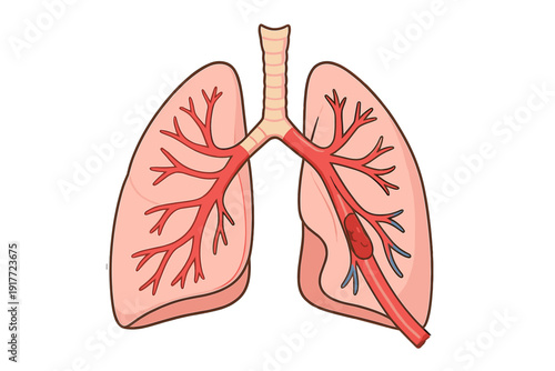 This medical diagram depicts human lungs and the bronchial tree. A prominent red blood clot is shown blocking a pulmonary vessel, representing a pulmonary embolism condition.