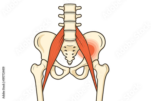 Medical illustration of the human pelvis and lumbar spine featuring the psoas major muscles. A red glow on the right hip indicates inflammation, strain, or localized pain.