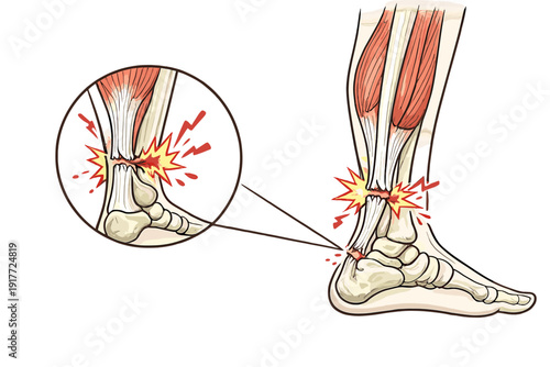 This medical illustration shows a ruptured Achilles tendon in a human foot and ankle. A circular inset provides a detailed view of the tear with red starbursts indicating acute pain.