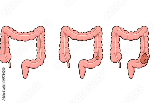 Three diagrams of the human large intestine illustrate the progression from a healthy state to the growth of a small polyp and a large malignant tumor in the colon.