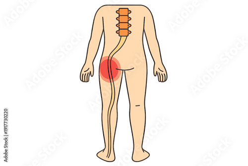 A medical illustration of a human figure from the back, highlighting the sciatic nerve and spinal column with a red glow indicating pain or inflammation in the hip and upper leg area.