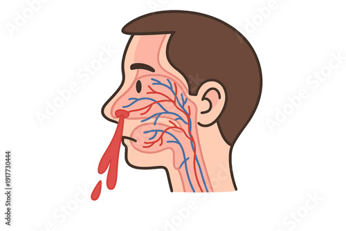 An illustration showing a side view of a person's head with a nosebleed. The diagram highlights the internal blood vessels and nasal cavity as blood drips from the nostril.