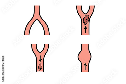 A medical illustration showing four diagrams of blood vessels, including a bifurcation, a blockage or plaque formation, and an aneurysm, with arrows indicating the direction of blood flow.