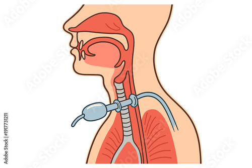 This medical illustration depicts a cross-section of the human head and neck, showing a tracheostomy tube inserted into the trachea. It clearly displays the respiratory and digestive tracts.