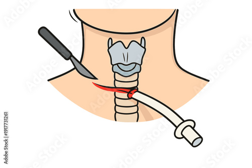 This medical illustration depicts a tracheostomy procedure on a human neck, showing a scalpel incision and the insertion of a breathing tube into the trachea for emergency airway management.