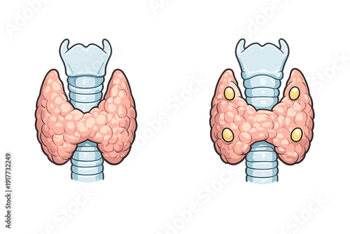 Medical illustration of the human thyroid gland and trachea. The right image shows the four parathyroid glands located on the posterior surface of the thyroid lobes against a black background.