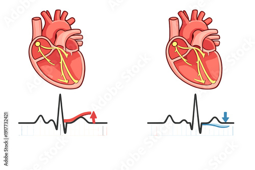 Medical illustration showing two human hearts with electrical conduction systems and corresponding electrocardiogram traces indicating ST-segment elevation and depression.