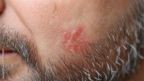 Extreme close up macro shot revealing a painful, inflamed red rash or allergic skin reaction patch appearing suddenly on the cheek of a middle aged man with salt and