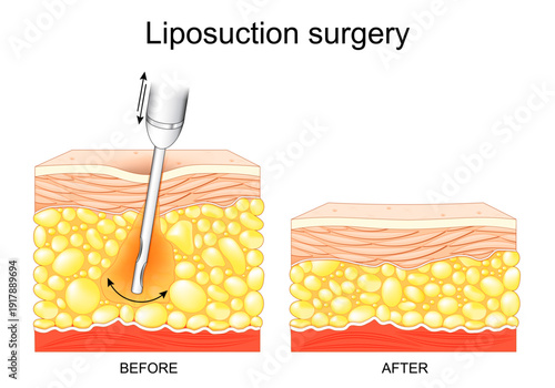 Liposuction surgery. Lipo. Before and after fat-removal procedure