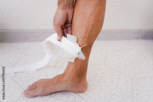 Canvas Print Removal of bandages and dressings after laser coagulation of veins on the shin a