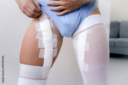 Removal of bandages and dressings after laser coagulation of veins on the inner thigh and groin area of men legs.
