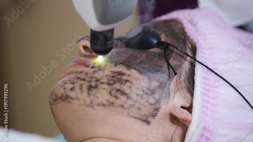Carbon Laser Peel Facial Treatment in Beauty Clinic