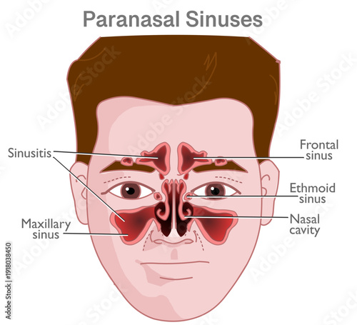 Paranasal air sinuses are air filled spaces present in the bones surrounding the nasal cavity. Frontal, ethmoid, sphenoid and maxilla. Illustration vector