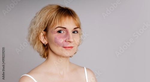 Foto Confident smiling blonde woman with visible port-wine stain birthmark vascular s