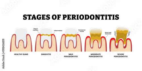 Stages of periodontitis stages. Steps of chronic bacterial gum infection process. Labeled healthy gums, gingivitis, mid, moderate, severe. Plague calculus. Inflammation teeth lose. Periodontal disease