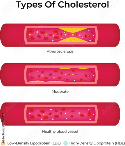 Types of Cholesterol Design Vector Illustration