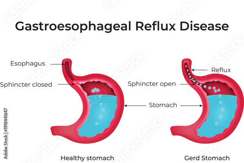 Gastroesophageal Reflux Disease Design Vector Illustration
