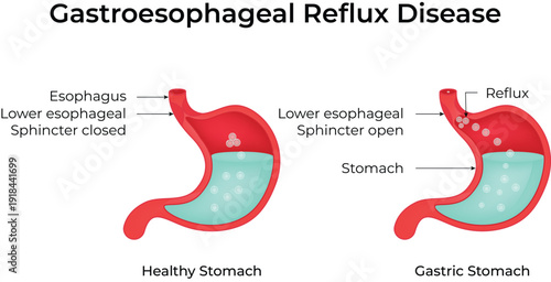 Gastroesophageal Reflux Disease Design Vector Illustration