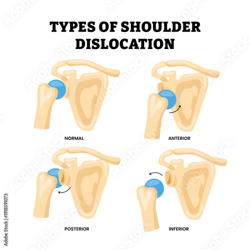 Different types of shoulder dislocation types. Labeled normal, anterior, posterior and inferior. Humeral head position diagram hand. Shoulder bone joint dislocation and separated with arm pain.