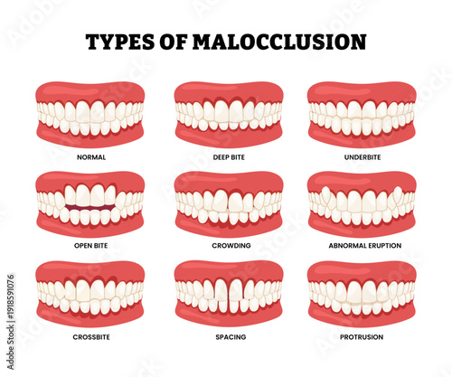 Different types of malocclusion dental types. Improper or Misalignment of teeth. Labeled normal, deep bite, underbite, open bite, crowding, abnormal eruption, crossbite, spacing, protrusion.