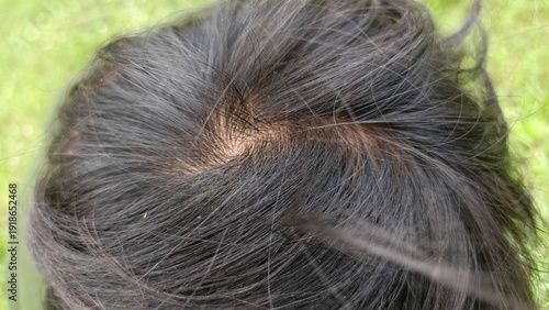 Close-up top view of human hair whorl showing natural scalp and black hair texture. Perfect for hair care topics, dermatology, alopecia awareness, genetics, and medical or cosmetic education