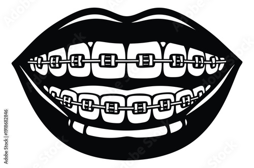 Line art illustration of a human mouth depicting teeth with dental braces for orthodontic treatment