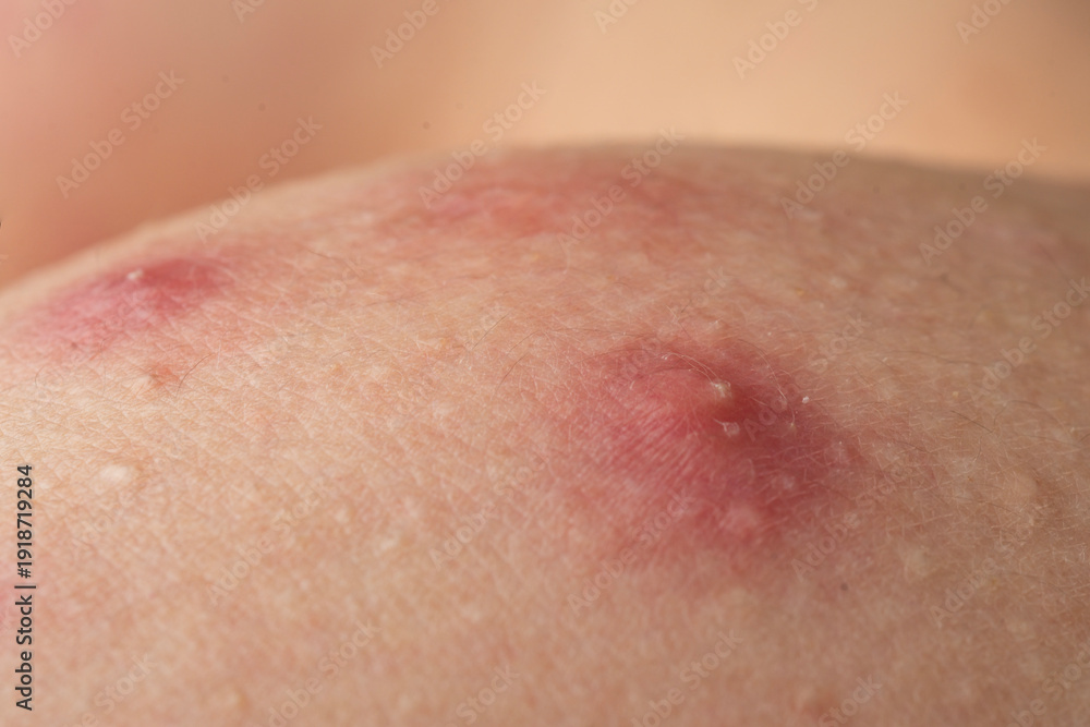 Fototapeta premium Acne skin pimple. Skin problem with inflamed bumps. Irritated skin texture. Close up skin issue.