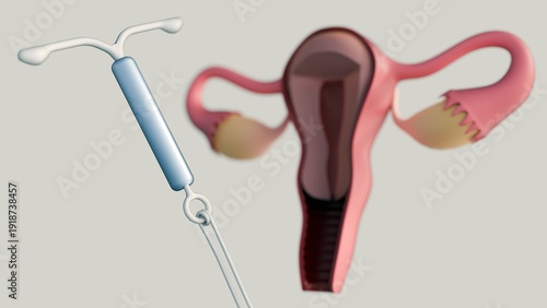 Billede på lærred A 3D rendering of a cross-sectional view of the female reproductive system featuring an Intrauterine Device or IUD
