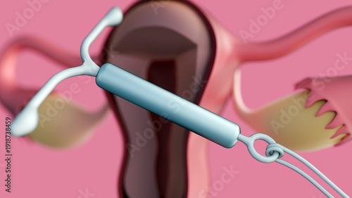 Billede på lærred A 3D rendering of a cross-sectional view of the female reproductive system featuring an Intrauterine Device or IUD