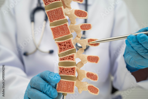 Doctor holding osteoporosis in back bone model for treatment medical in orthopedic department.