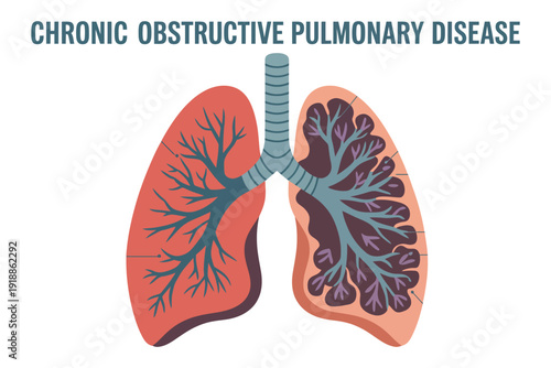 COPD chronic obstructive pulmonary disease illustration of human lungs