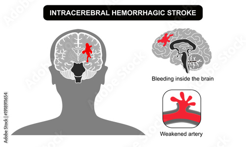 Brain stroke hemorrhagic Intracerebral. Arteriosclerosis, infarct, ischemia, thrombosis disease. Cholesterol in human blood vessels. Medical poster vector illustration.
