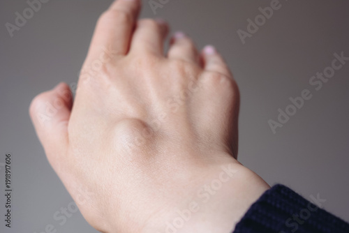 Canvastavla Female right back hand with ganglion cyst on the dorsum,  fluid-filled bump associated with a joint or tendon sheath, close-up view, selected focus