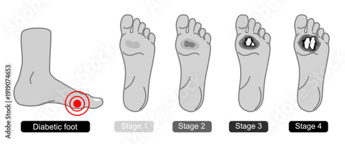 Diabetic foot syndrome stages. Foot wounds, deep ulcers, open wounds. Inflammation, infection, and amputation. Flat Vector illustration for medical, diagnostic, and education.
