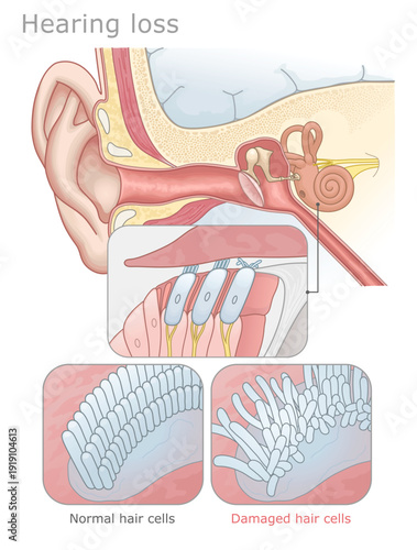 Hearing loss caused by damaged hair cells in the human ear diagram. Ear Anatomy Series.