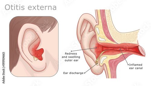 Otitis externa outer ear infection diagram. Medical diagram of outer ear infection or otitis externa showing inflamed ear. Ear Anatomy Series.
